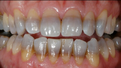 Dental Stain