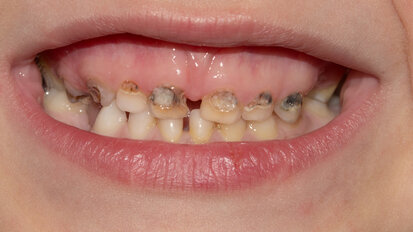 Childhood Caries and Supernumerary Tooth Removal: A Clinical Evaluation of Pediatric Patients in a School-Based Dental Program