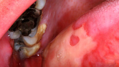 Oral Complications of Cancer Therapy Part 1: Conventional Chemotherapy and Targeted Anticancer Agents