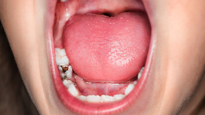 A Review of the Hall Technique: A minimally invasive option for treating carious primary molars