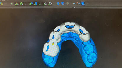 Placing an implant predictably using 3-D workflow, and surgical guide