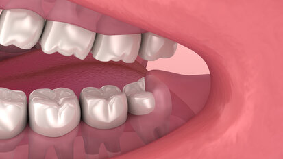 Management of Wisdom Teeth for the General Dentist