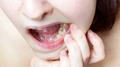 Non-invasive/non-restorative treatment of caries lesions