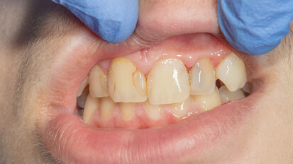 Recurrent Caries