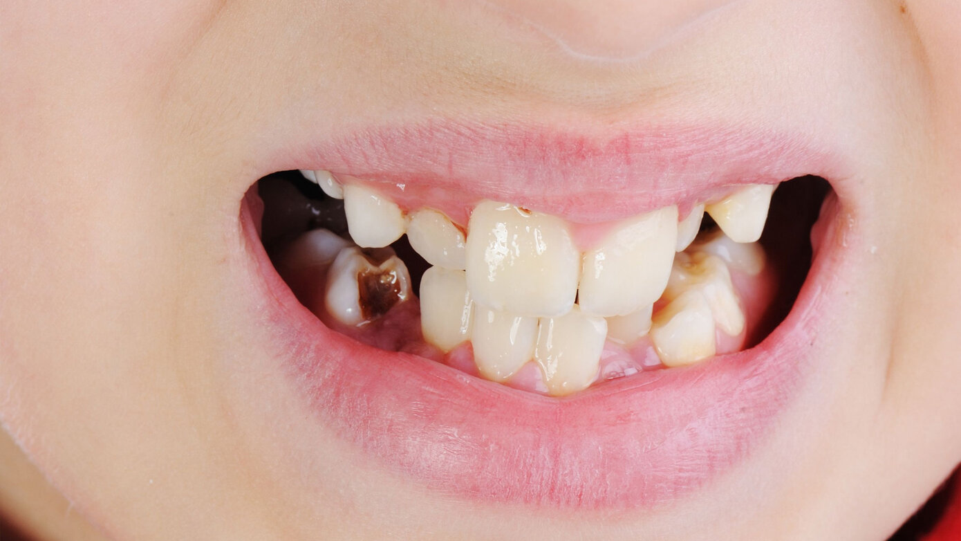 Early Childhood Caries: Risk Factors, Oral Health-related Quality of Life and Interprofessional Collaboration