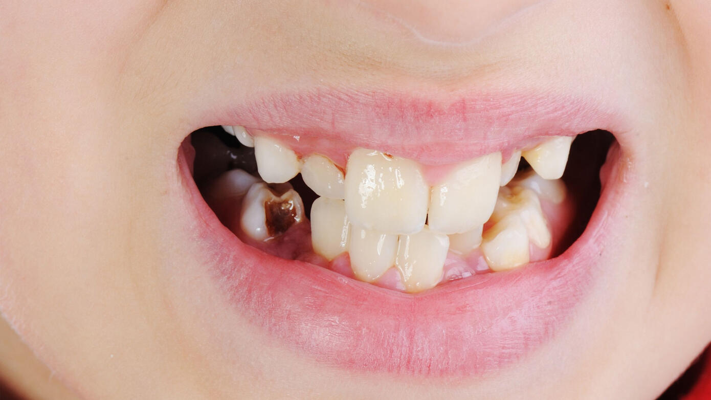 Early Childhood Caries: Risk Factors, Oral Health-related Quality of Life and Interprofessional Collaboration