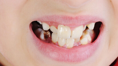 Early Childhood Caries: Risk Factors, Oral Health-related Quality of Life and Interprofessional Collaboration