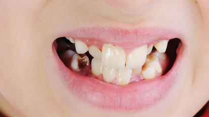Early Childhood Caries: Risk Factors, Oral Health-related Quality of Life and Interprofessional Collaboration