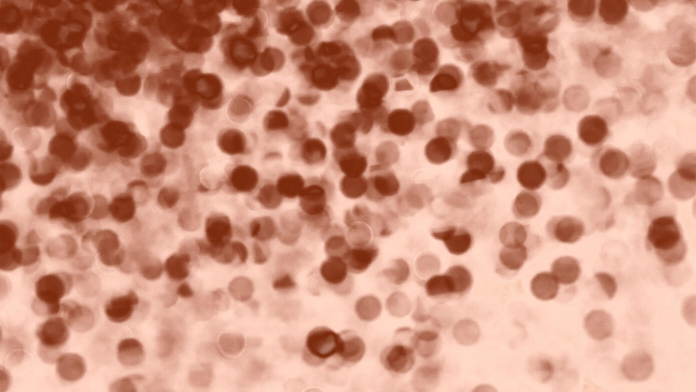 Measles: Concerns and Implications for Dental Professionals