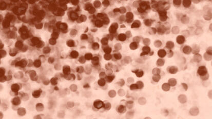 Measles: Concerns and Implications for Dental Professionals