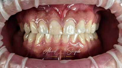 Bruxism, parafunctional habits, and aesthetics reconstruction