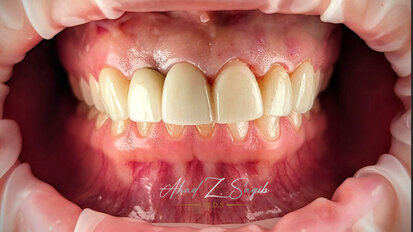 A smile makeover; going from Point A to Point B