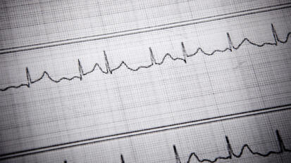 Cardiac Arrhythmias