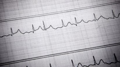 Cardiac Arrhythmias