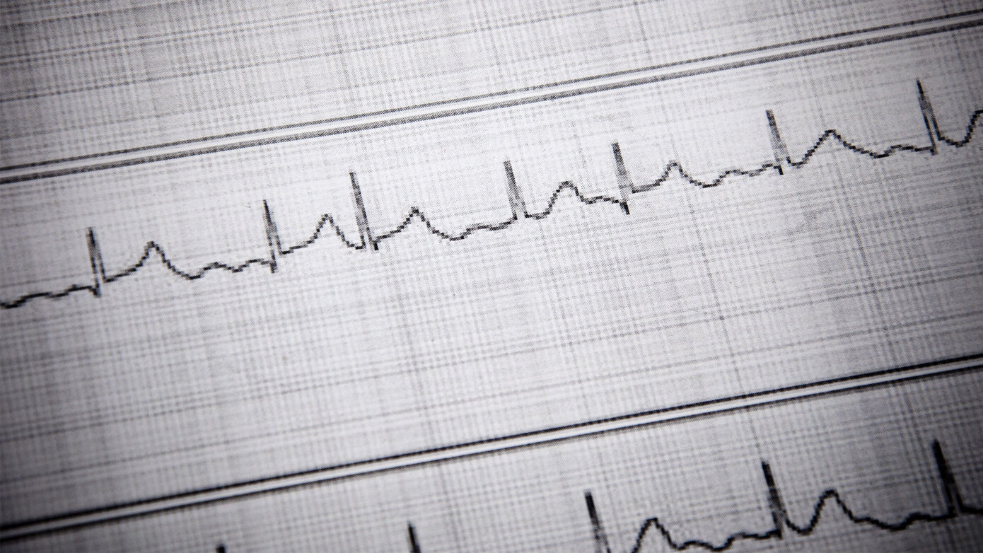 Cardiac Arrhythmias