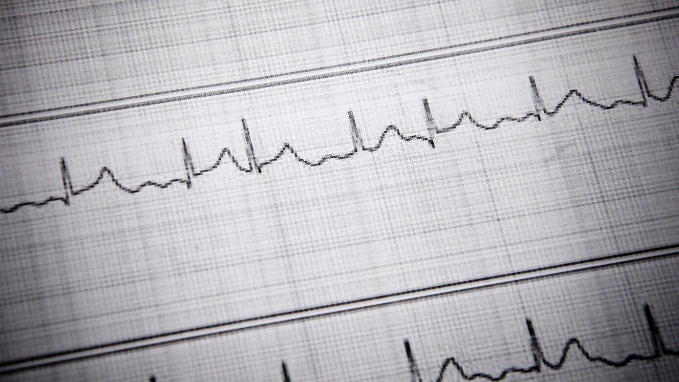 Cardiac Arrhythmias