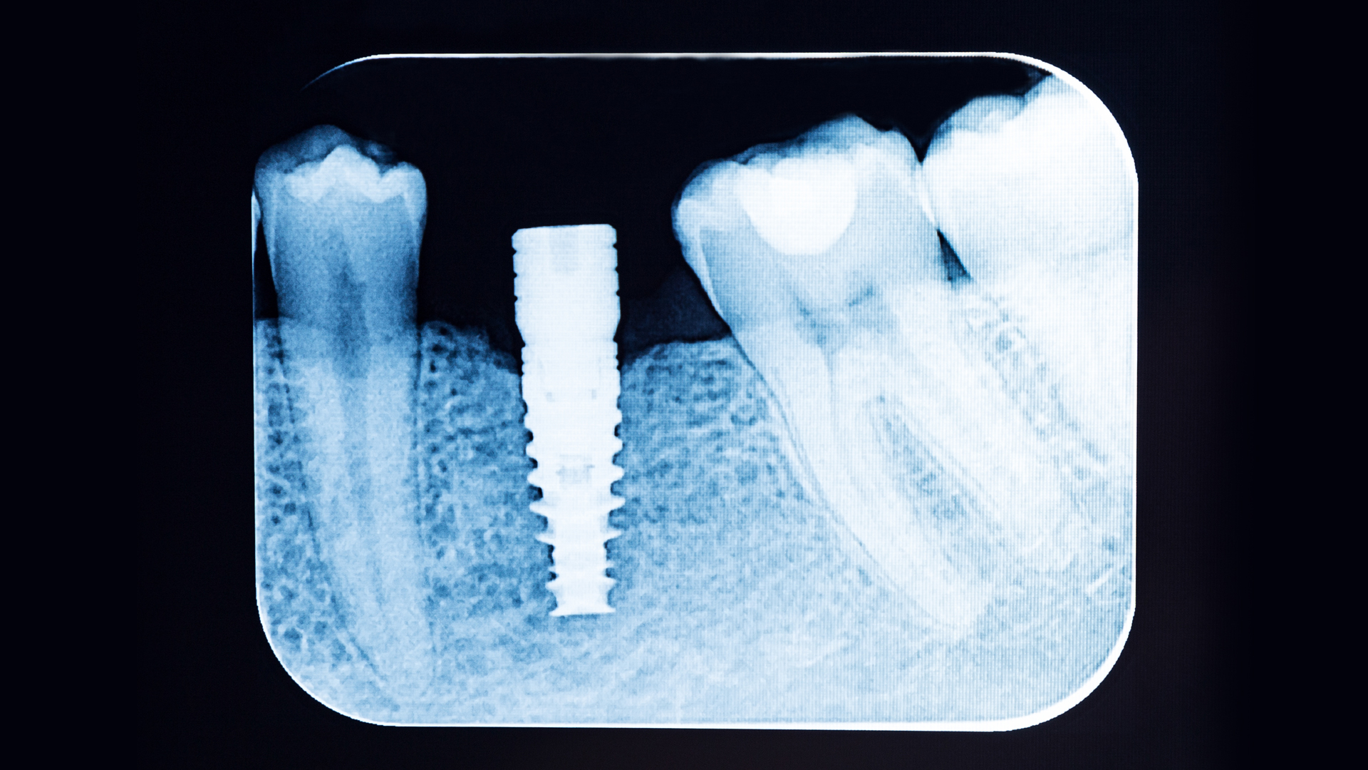 Systemic Health and Implant Failure