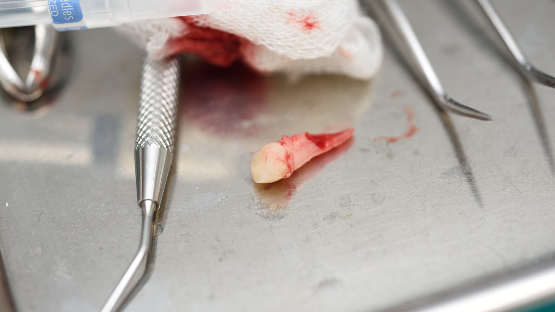 Tooth Avulsion