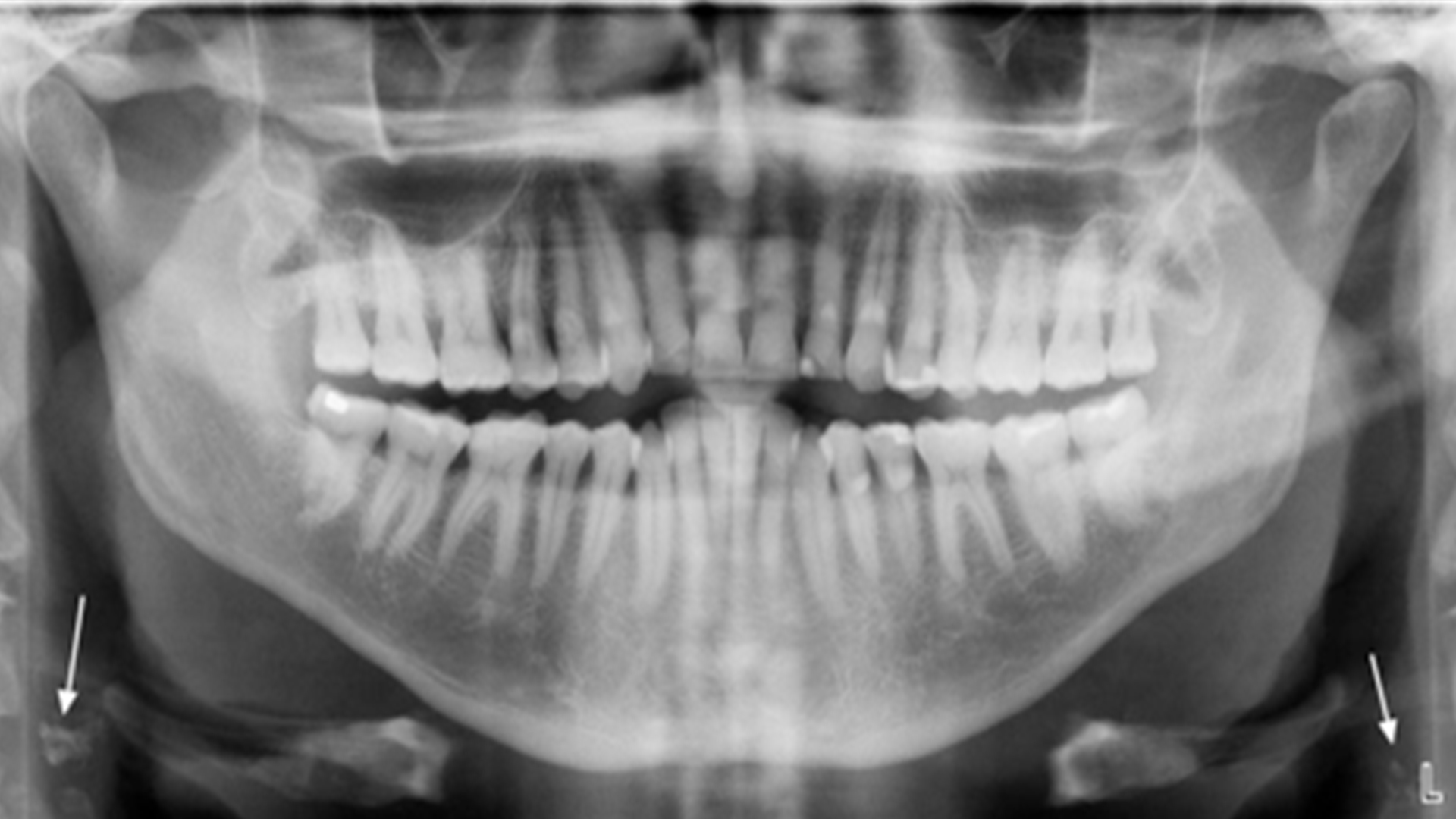 Identification of Carotid Artery Calcifications in Panoramic Dental Radiographs Identification of Carotid Artery Calcifications in Panoramic Dental Radiographs