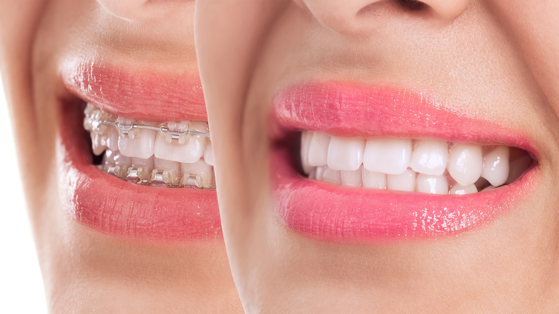 Management of White Spot Lesion Prevention for a Patient under Ortho Treatment Management of White Spot Lesion Prevention for a Patient under Ortho Treatment