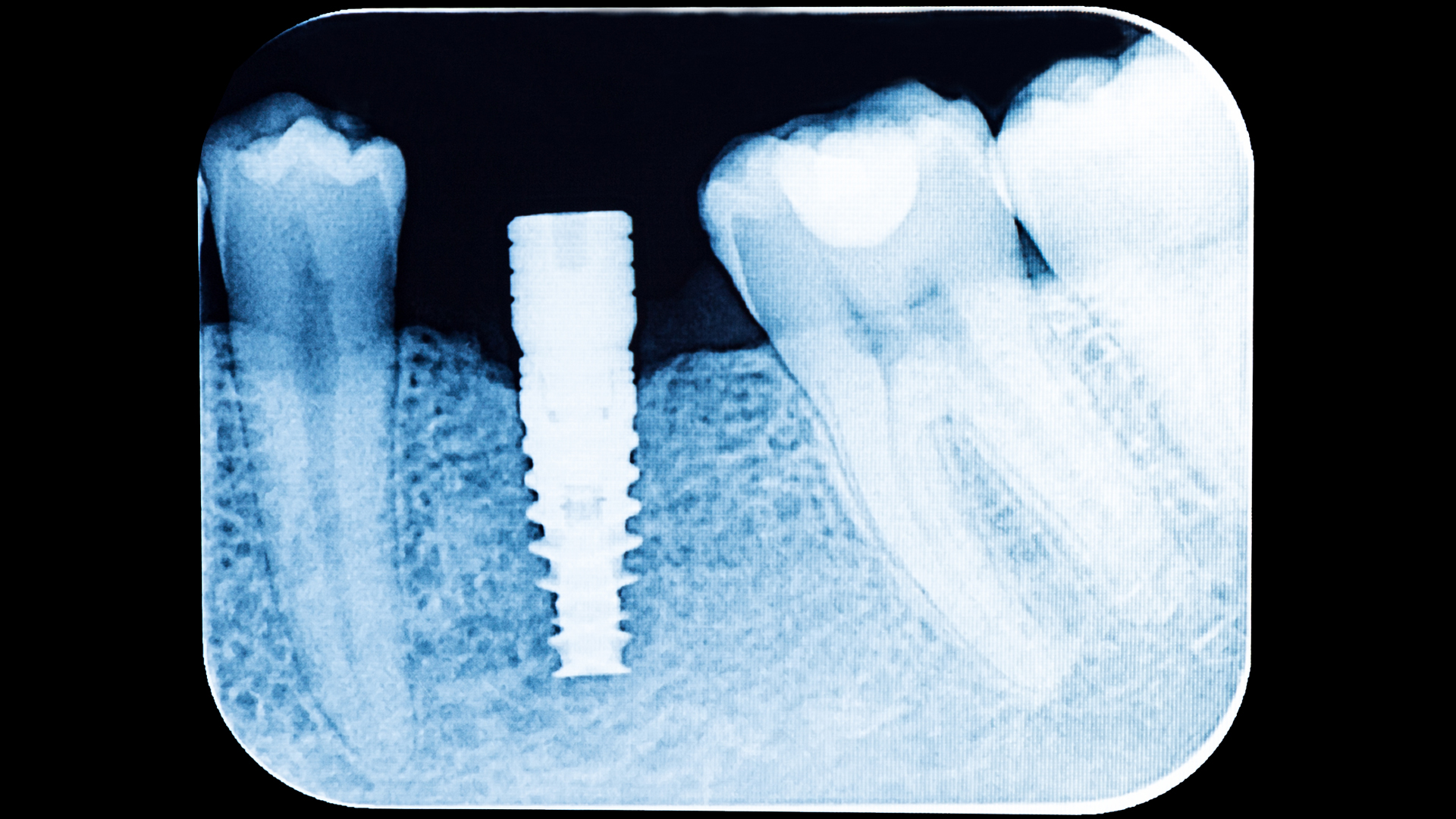 Periodontitis and Implant Complications: Update on the Linkage Periodontitis and Implant Complications: Update on the Linkage
