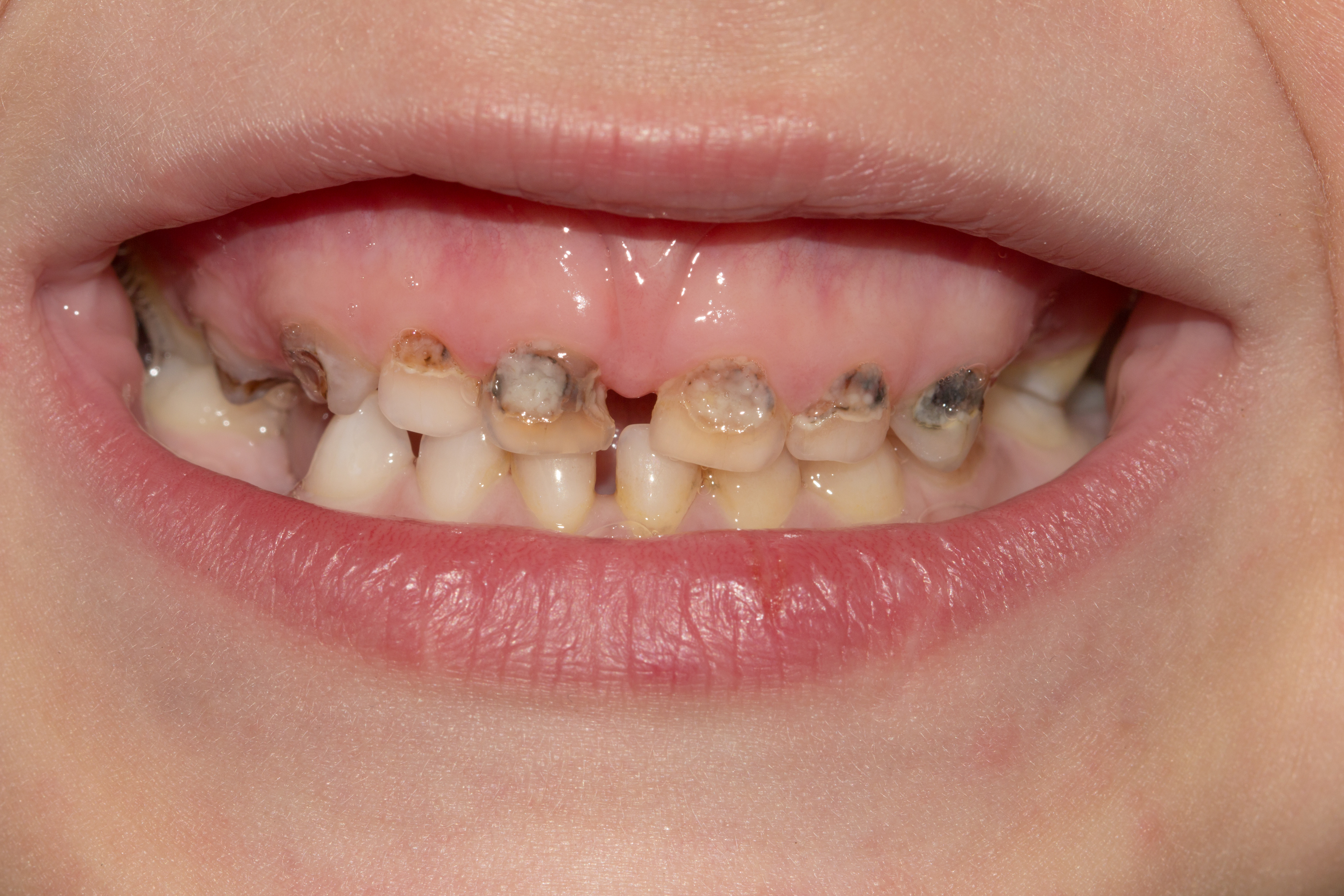 Childhood Caries and Supernumerary Tooth Removal: A Clinical Evaluation of Pediatric Patients in a School-Based Dental Program Childhood Caries and Supernumerary Tooth Removal: A Clinical Evaluation of Pediatric Patients in a School-Based Dental Program