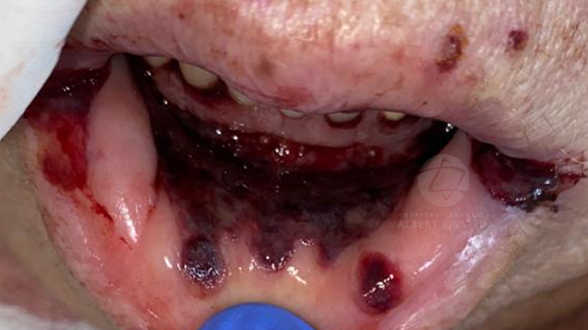 COVID-19 and oral cavity COVID-19 and oral cavity