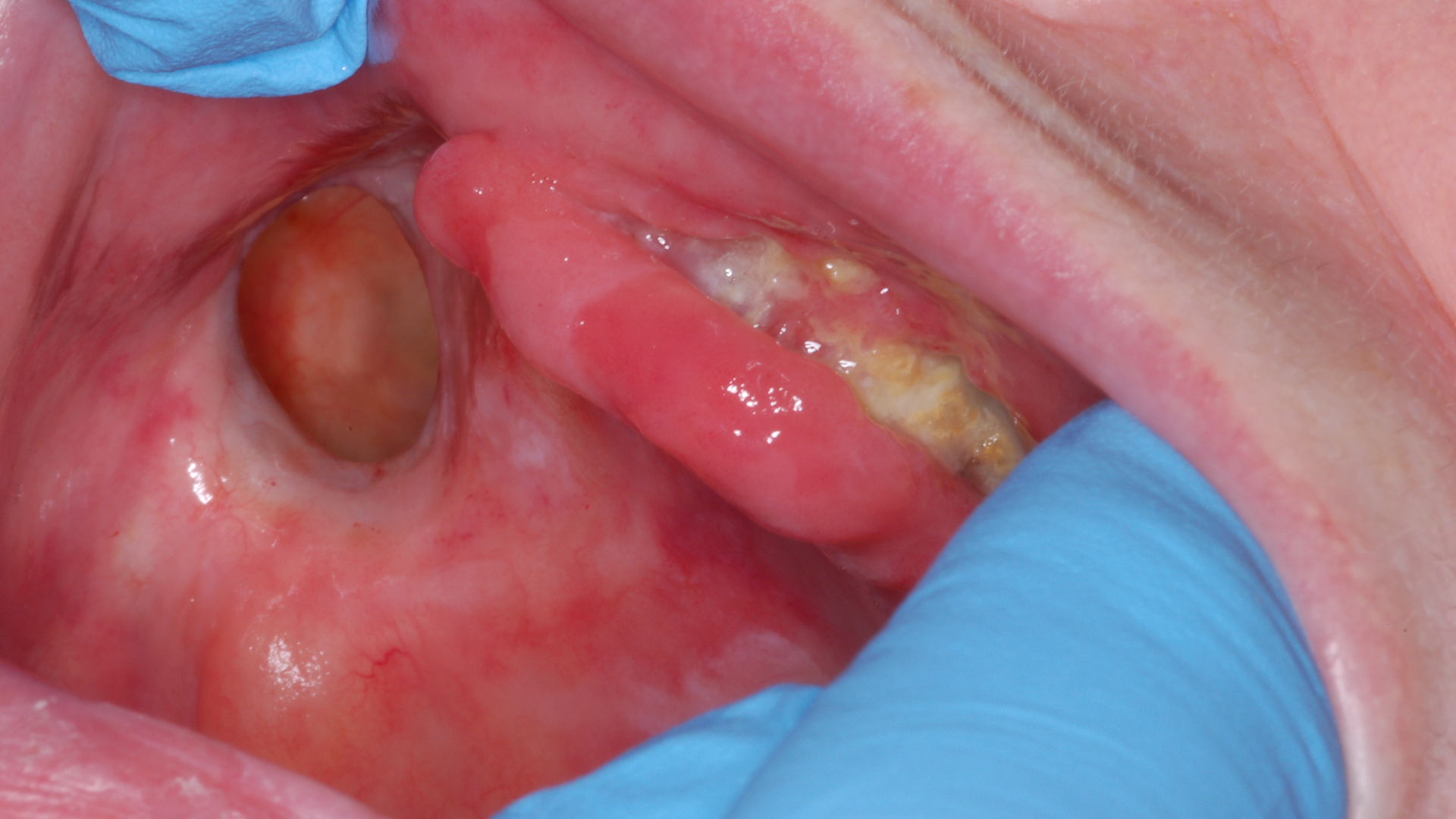 Oral Complications of Cancer Therapy Part 2: Radiation Therapy and Medication-related Osteonecrosis of the Jaw Oral Complications of Cancer Therapy Part 2: Radiation Therapy and Medication-related Osteonecrosis of the Jaw