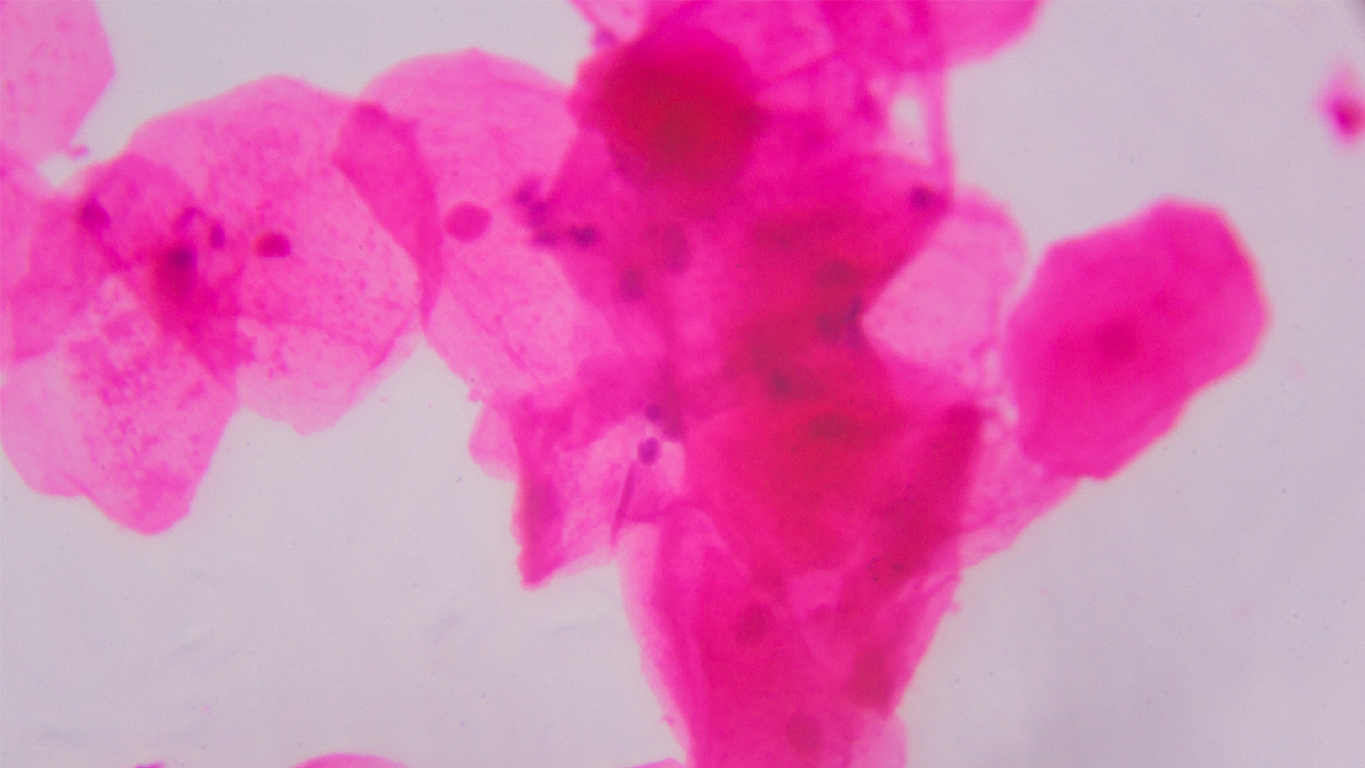 The Relationship of Periodontal Disease and Oral Squamous Cell Cancer