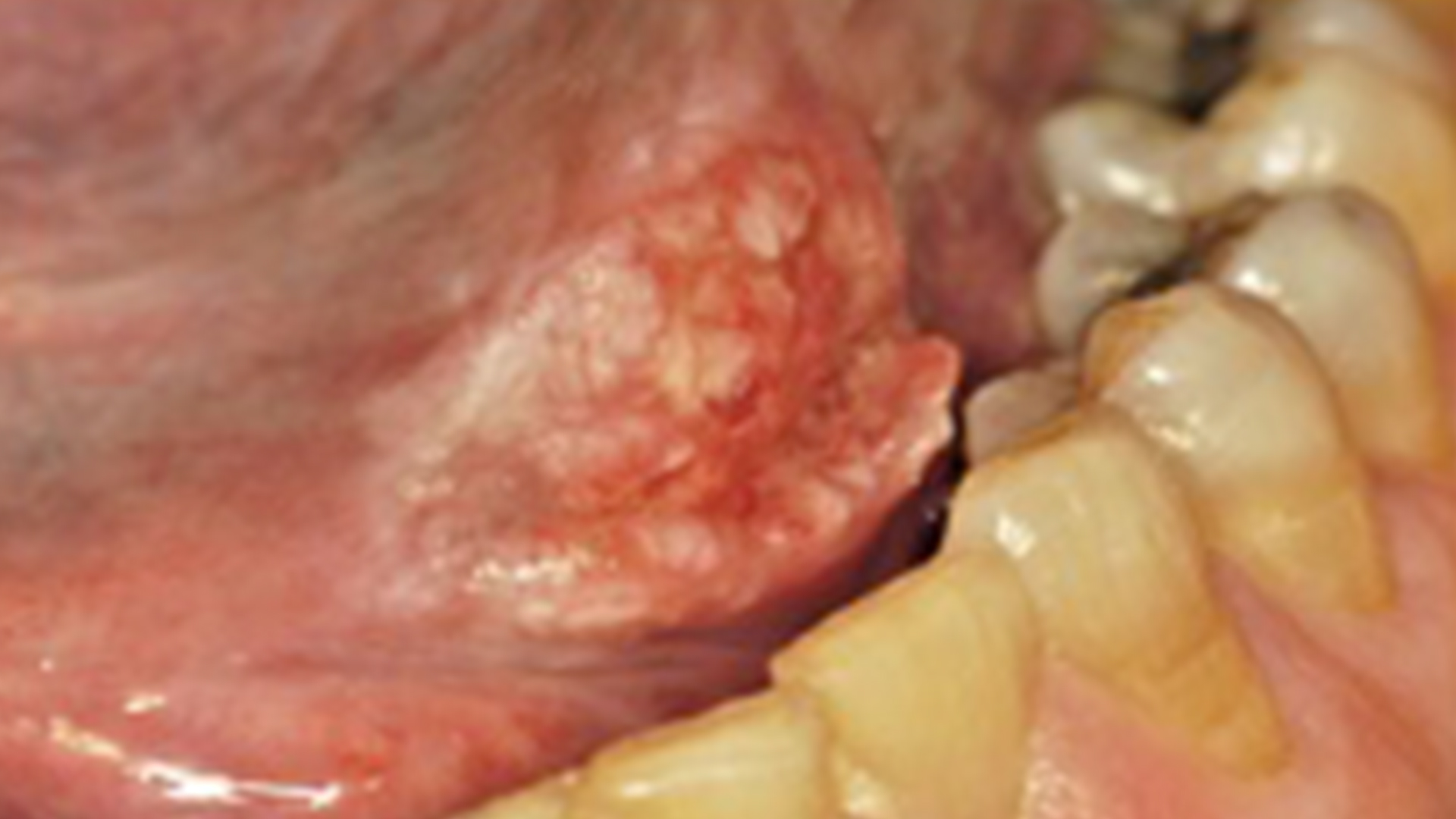 Oral Mucosal Premalignant Diseases and Squamous Cell Carcinoma Oral Mucosal Premalignant Diseases and Squamous Cell Carcinoma