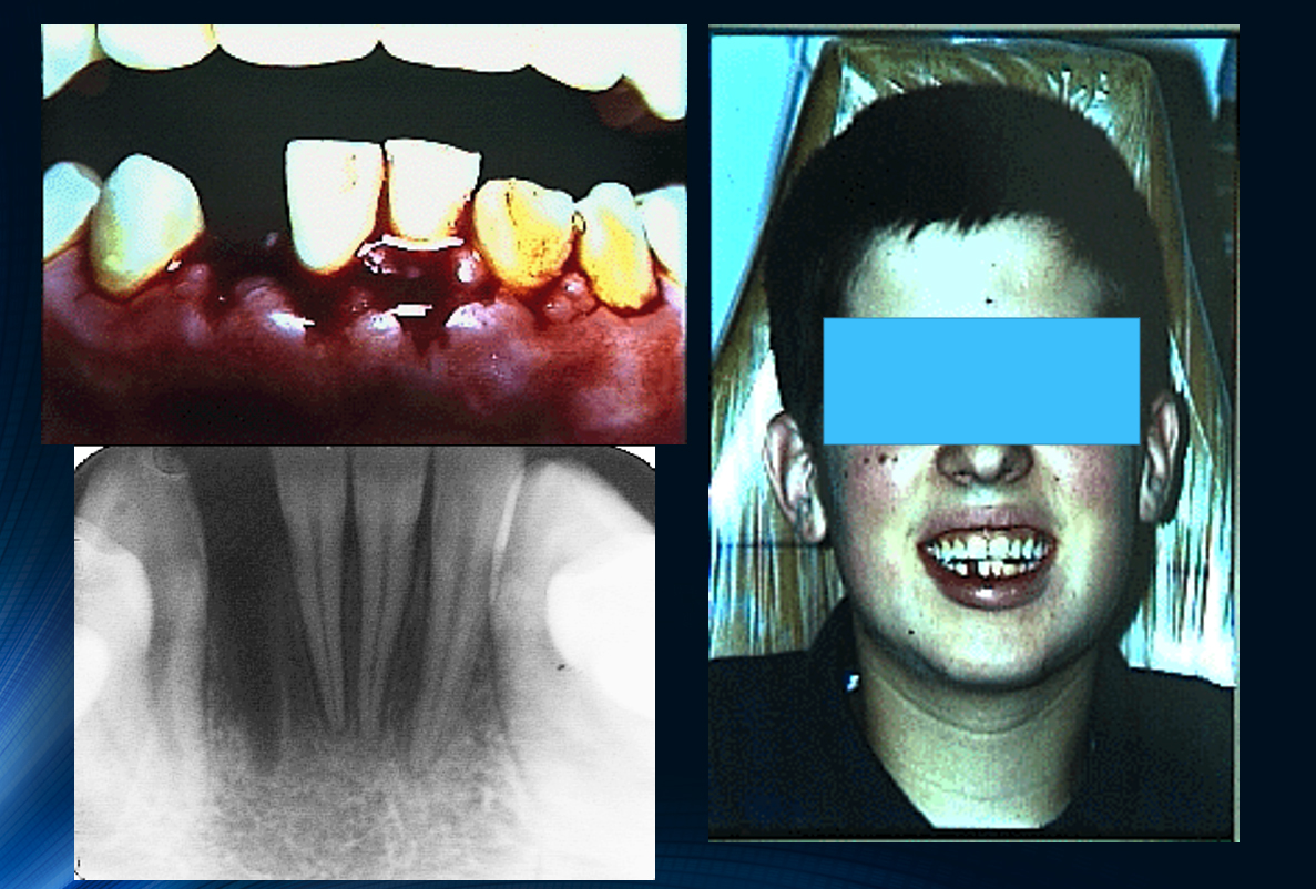 Update on Dental Trauma