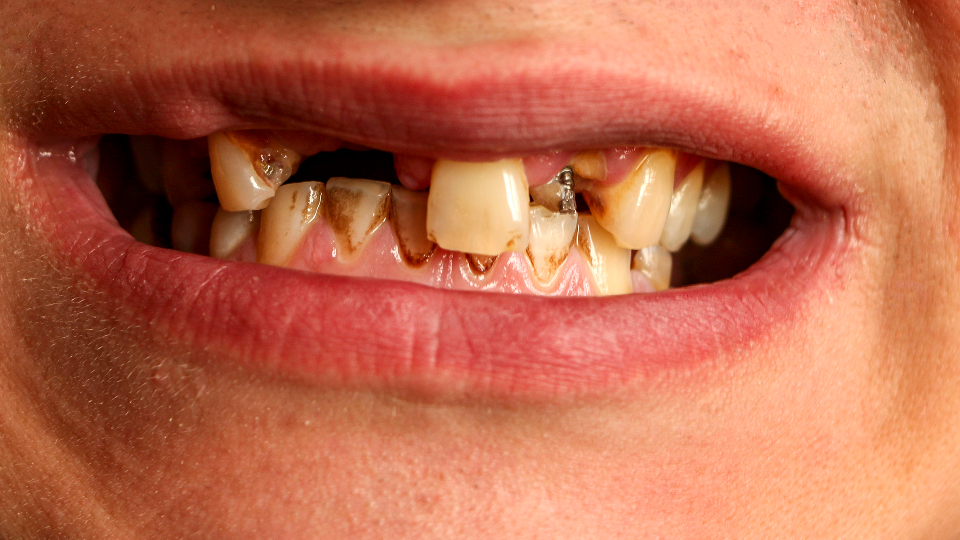 Dental Management of Common Disabilities