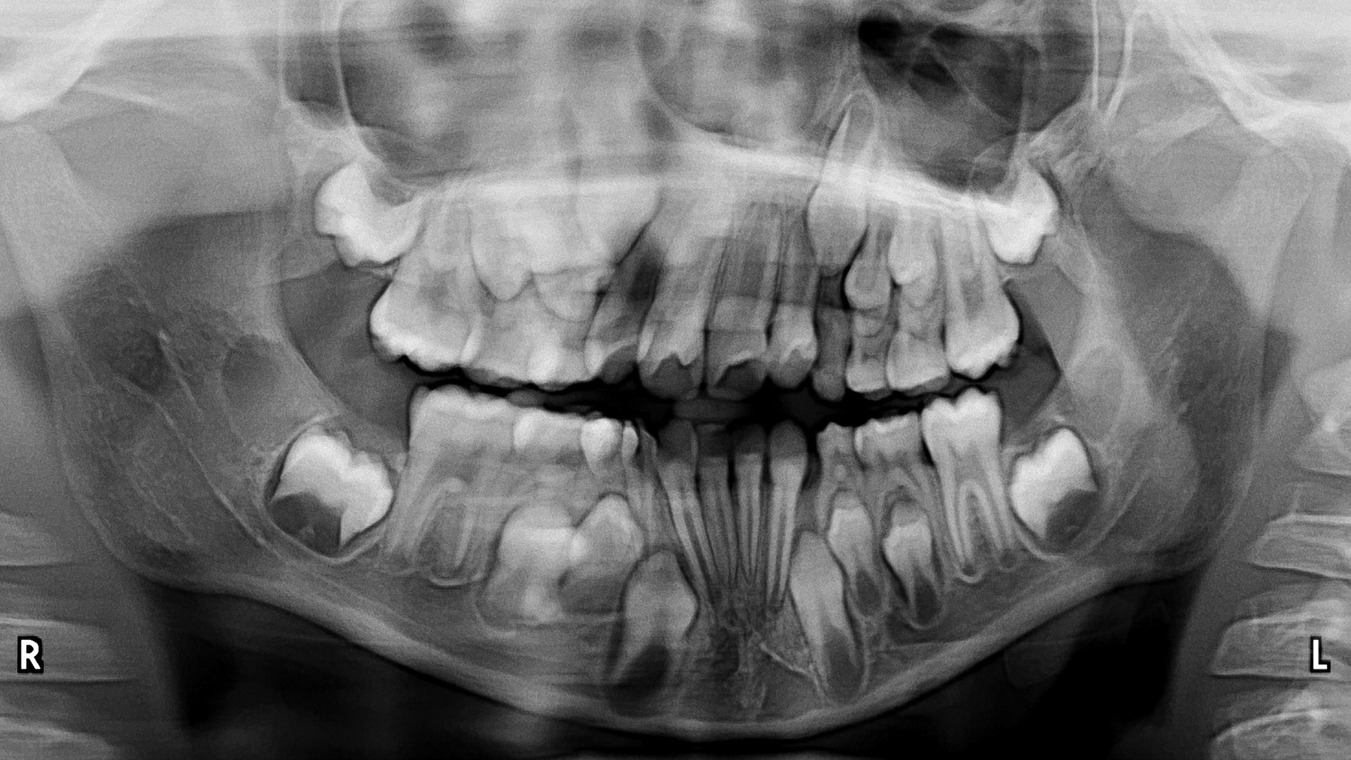 Variants of normal radiologic anatomy that may simulate disease on panoramic images Part 2 Variants of normal radiologic anatomy that may simulate disease on panoramic images Part 2