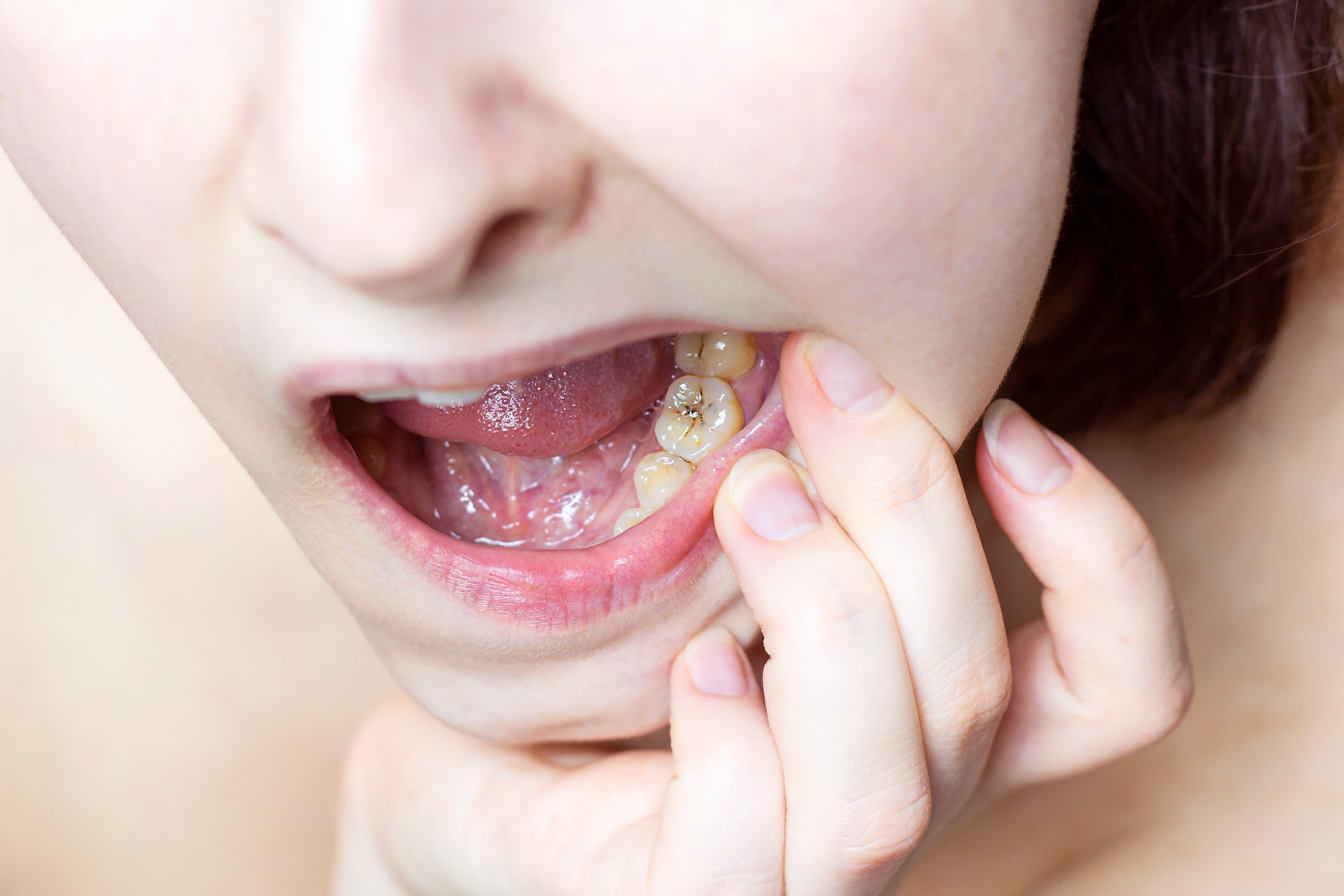 Non-invasive/non-restorative treatment of caries lesions