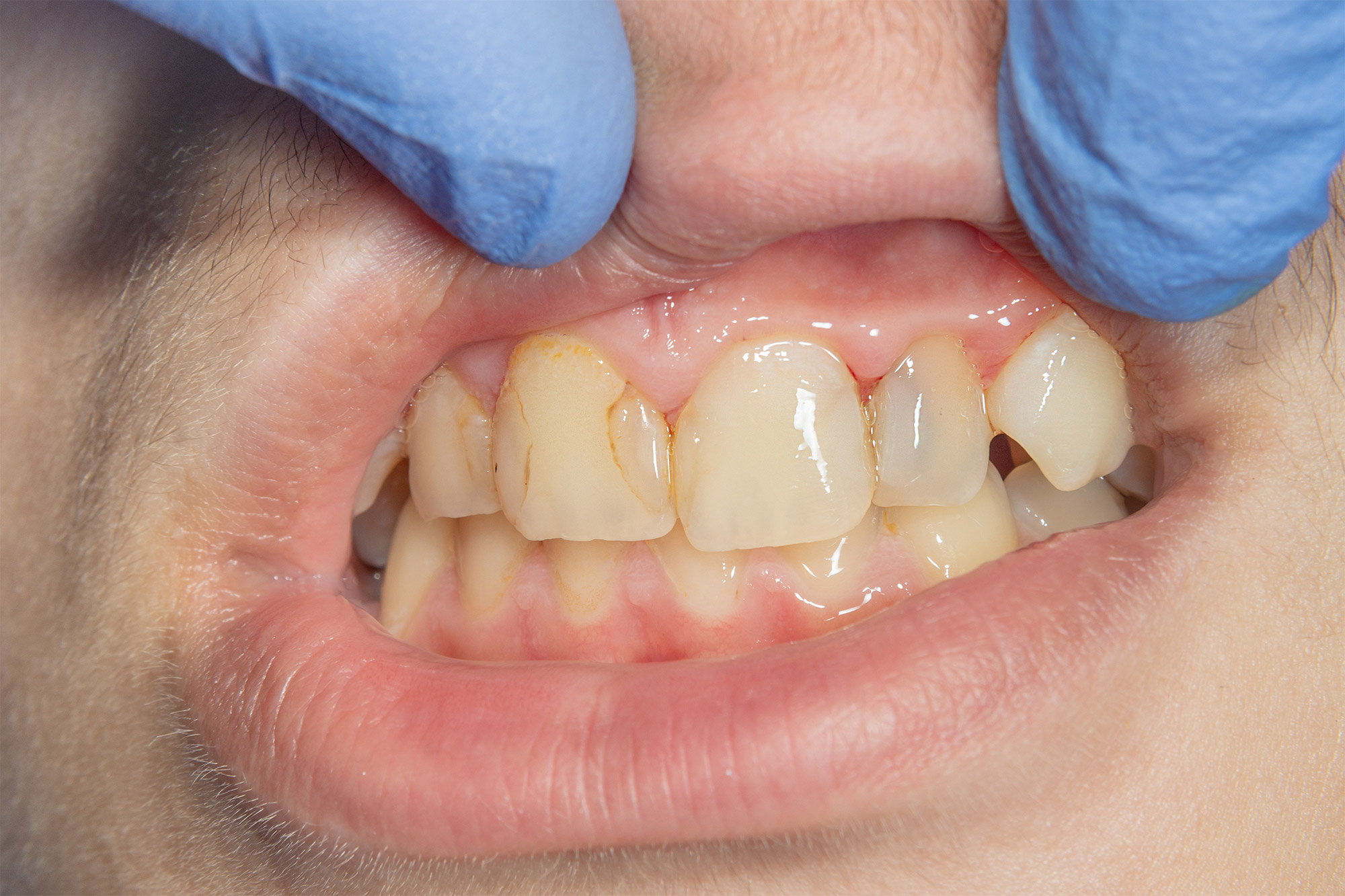 Recurrent Caries