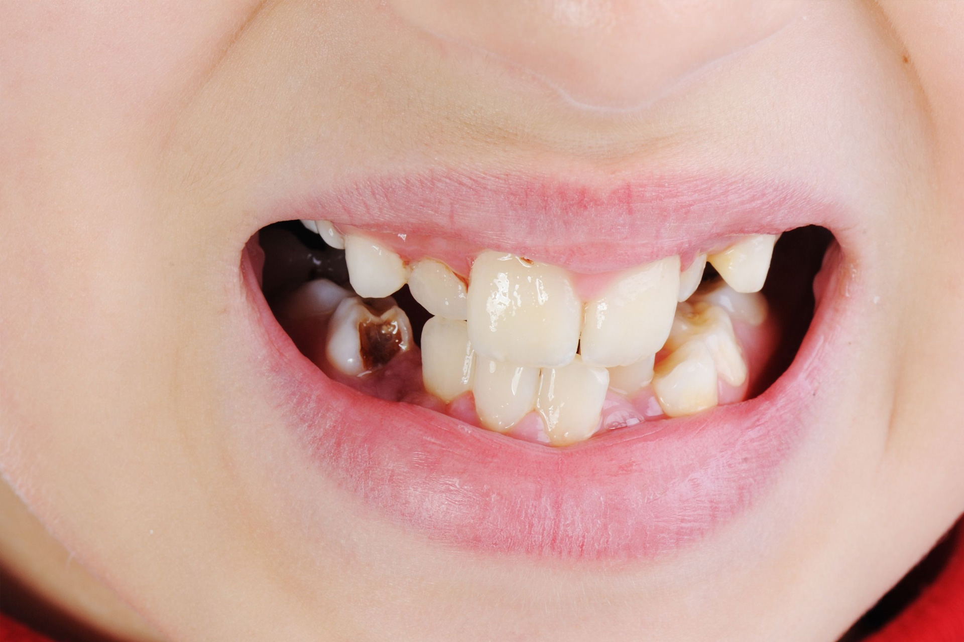 Early Childhood Caries: Risk Factors, Oral Health-related Quality of Life and Interprofessional Collaboration