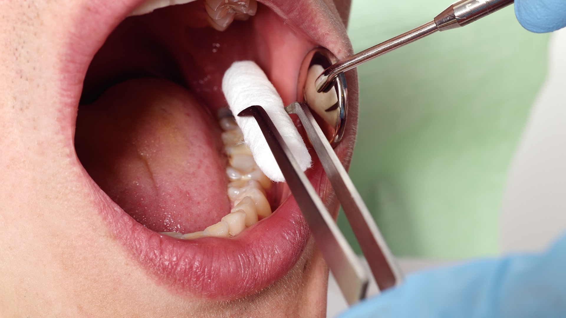 You Got This! Diagnosis and Management of Common Oral Lesions