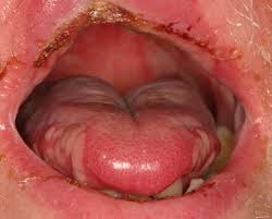 Oral Mucositis: Oral Impact, Sequelae and Management Oral Mucositis: Oral Impact, Sequelae and Management