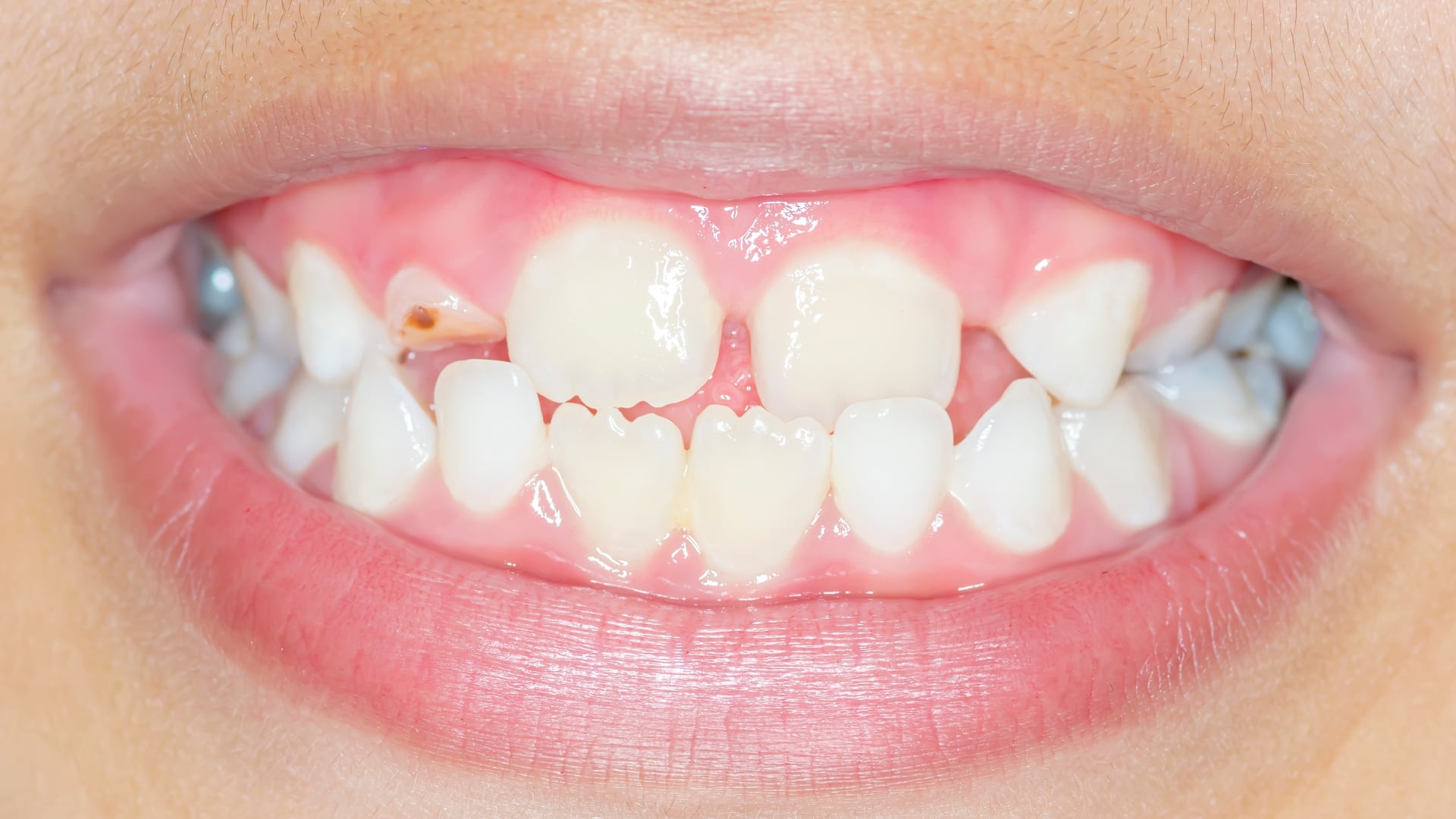 Paediatric Dentistry Evidence Uncovered: Global Consensus in Action Paediatric Dentistry Evidence Uncovered: Global Consensus in Action