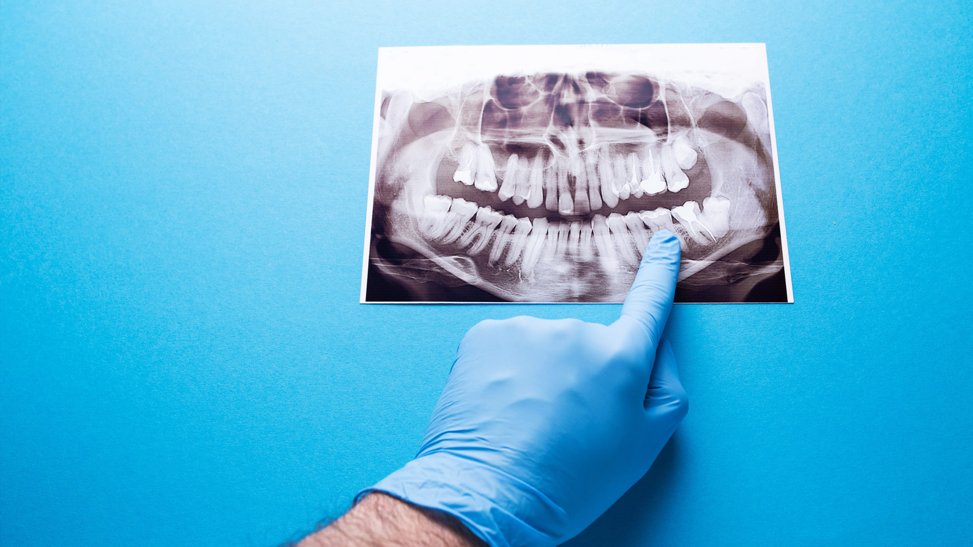 Mystery Lesion on Panoramic Film