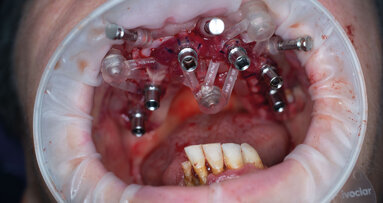 Riabilitazione full-arch a carico immediato guidato con dime scomposte e impianti EVO GHIMAS