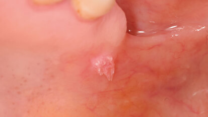 Effetti della Zn-L-Carnosina sulle lesioni della mucosa orale: case report