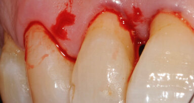 L’applicazione del protocollo  Clean&Seal nel trattamento delle  tasche parodontoli: un case report