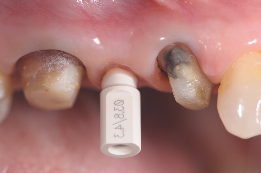 Fig. 8 - Posizionamento dello scan body dell’impianto Conelog utilizzato dal diametro di 4.3.