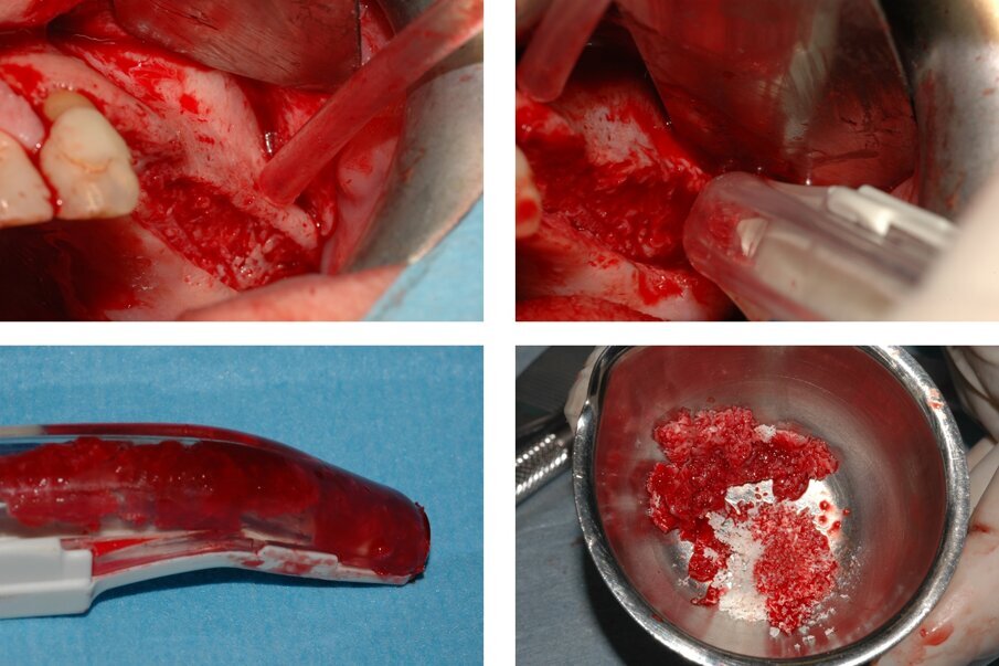Fig. 2_Aperto un lembo a tutto spessore si è proceduto a raccogliere del particolato autologo da miscelare con un sostituto osseo granulare.