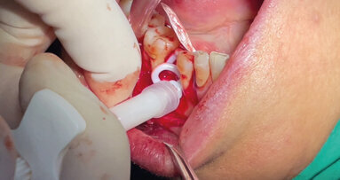 Rigenerazione ossea tramite membrana non riassorbibile e materiale alloplastico nella perdita di volume parodontale post-estrattiva