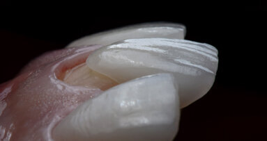 Technology and emotion: A porcelain veneer case report