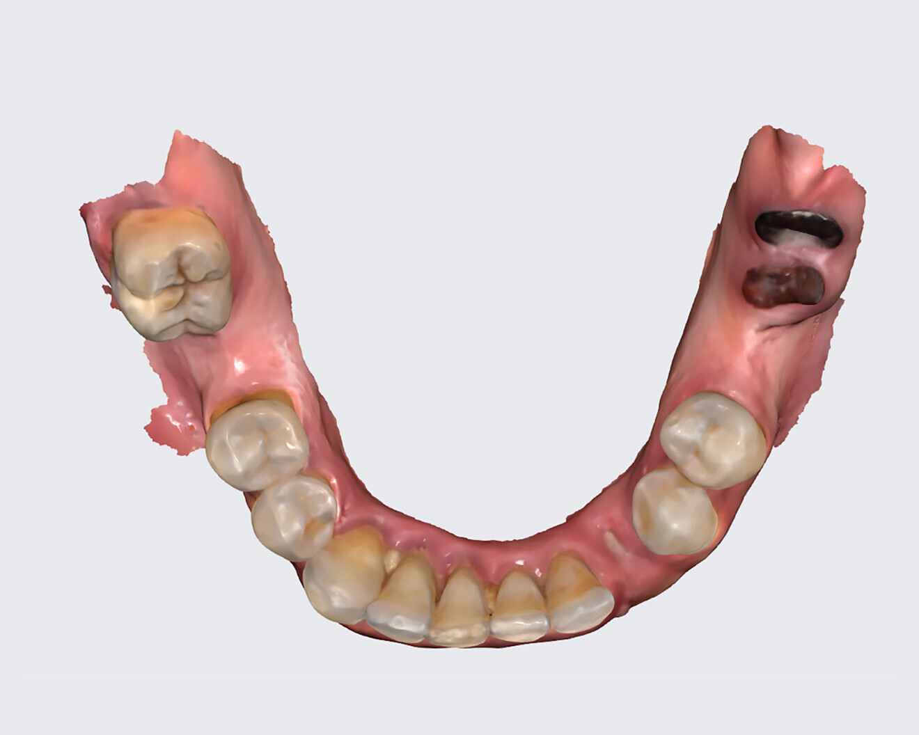 Fig. 11b: Maxillary intra-oral scan.