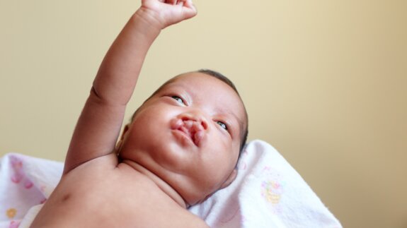 CBCT voor kinderen met schisis kan met minder hoge stralingsdosis