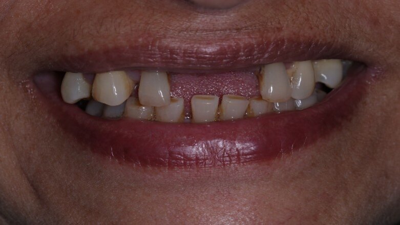 Poor dental health may indicate diabetes risk